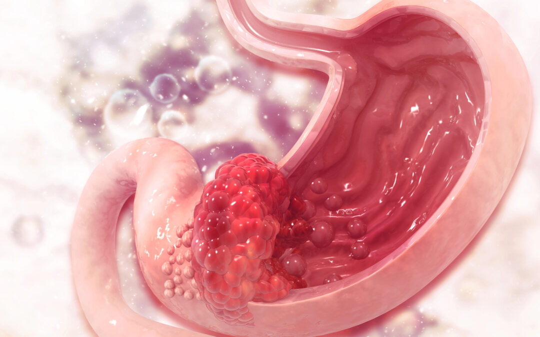 Câncer de estômago: conheça os fatores de risco e os sinais de alerta